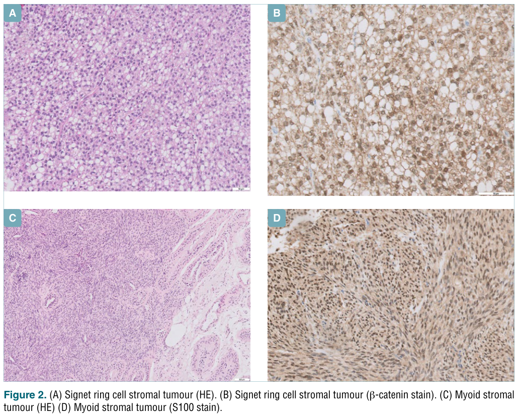 ## Context ID: pqac-00000016 I have extracted Figure 2 and Figure 3 from the document as requested. Figure 2 shows the signet ring cell stromal tumour and the m